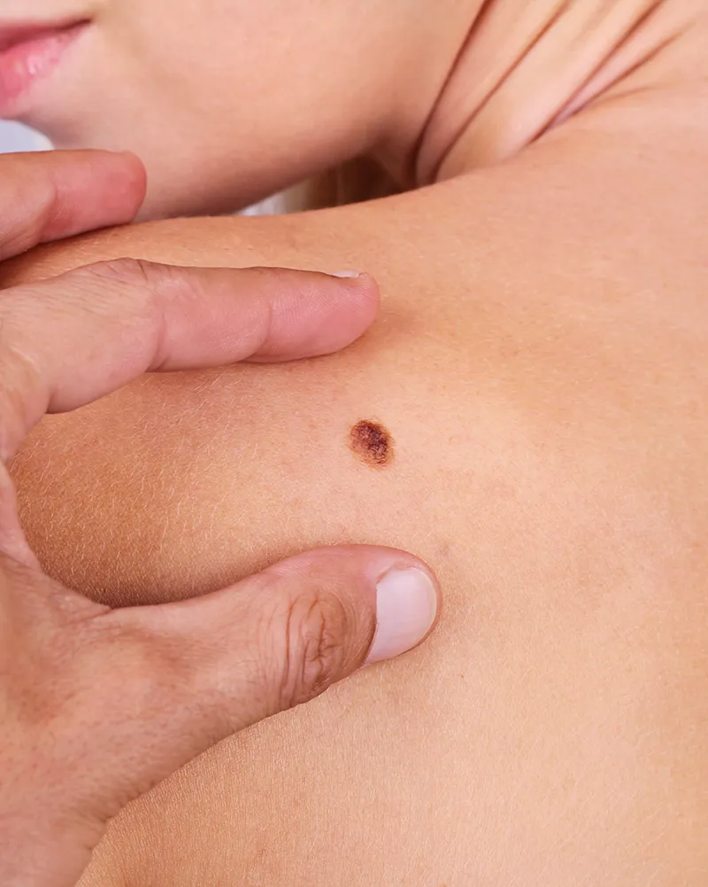 Cancérologie dermatologique : oncodermatologie