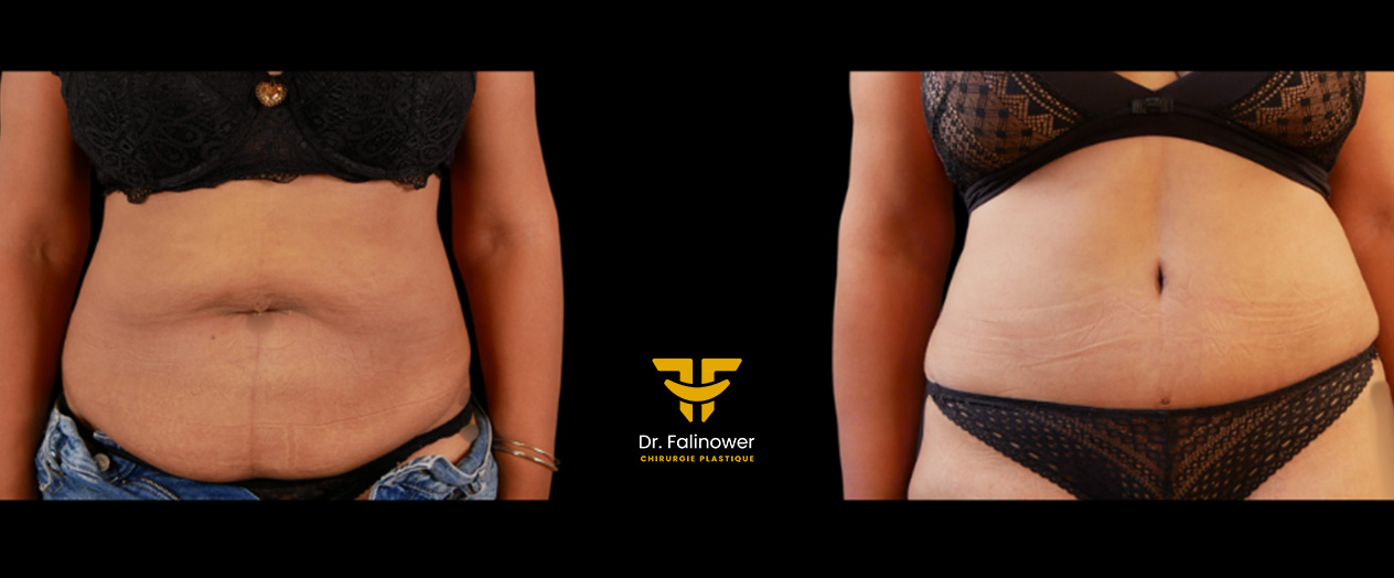 Abdominoplastie patiente 1 face