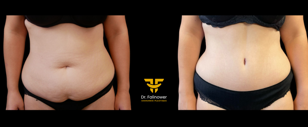 Abdominoplastie patiente 2 face