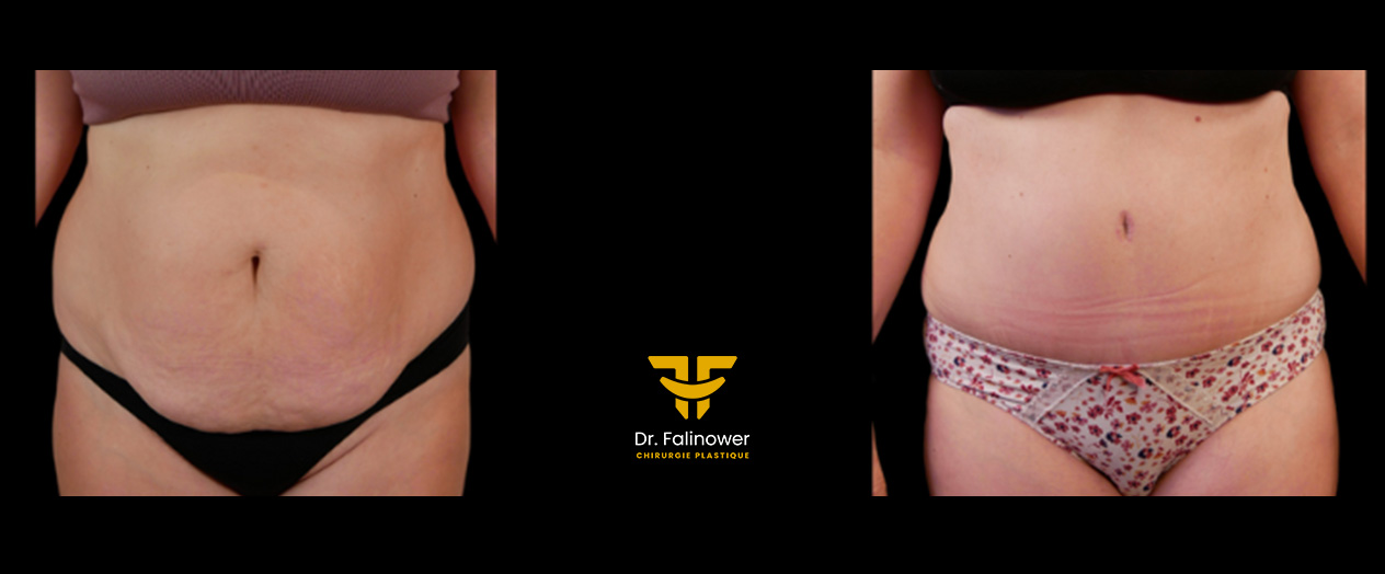 Abdominoplastie patiente 3 face