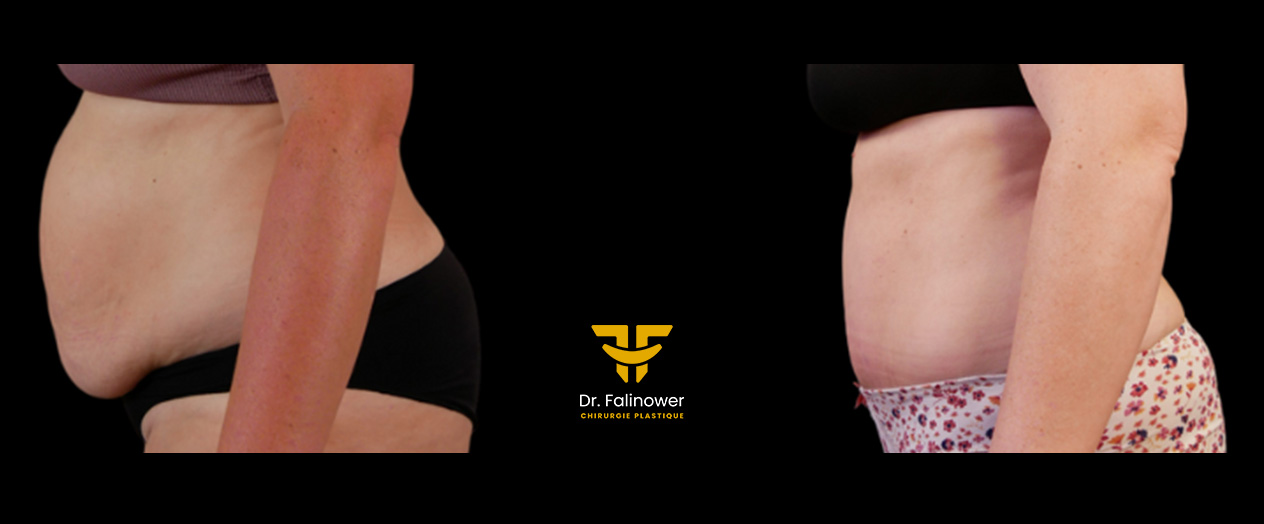 Abdominoplastie patiente 3 gauche