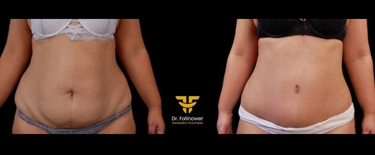 Abdominoplastie patiente 4 face
