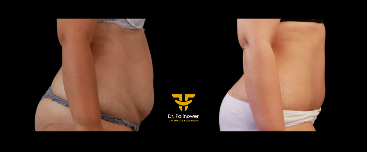 Abdominoplastie patiente 4 droit