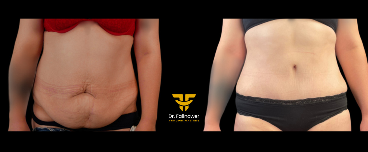 Abdominoplastie patiente 5 face