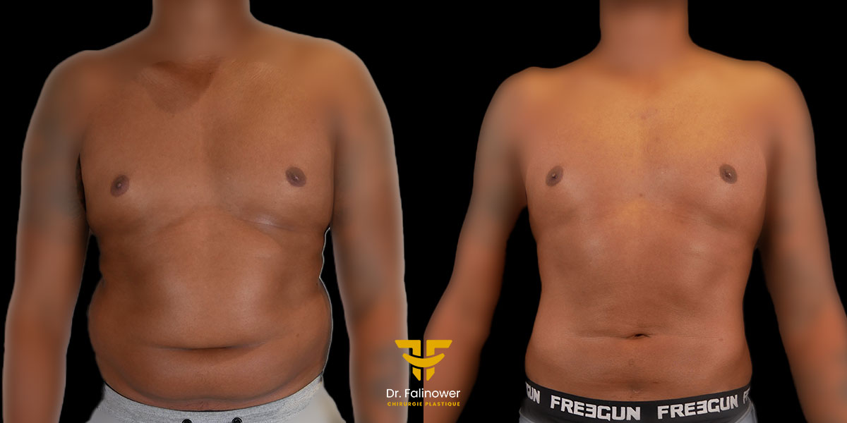 Lipoaspiration du corps patient 1 face