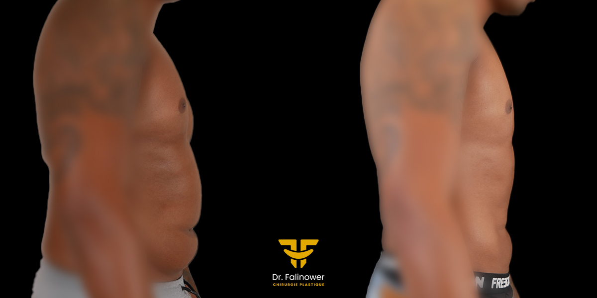 Lipoaspiration du corps patient 1 profil gauche