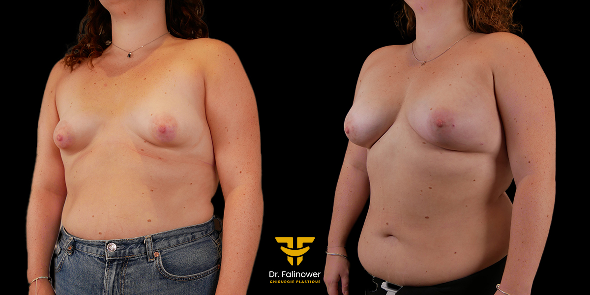 Lipofilling mammaire patient 1