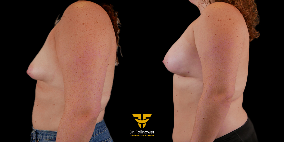 Lipofilling mammaire patient 1