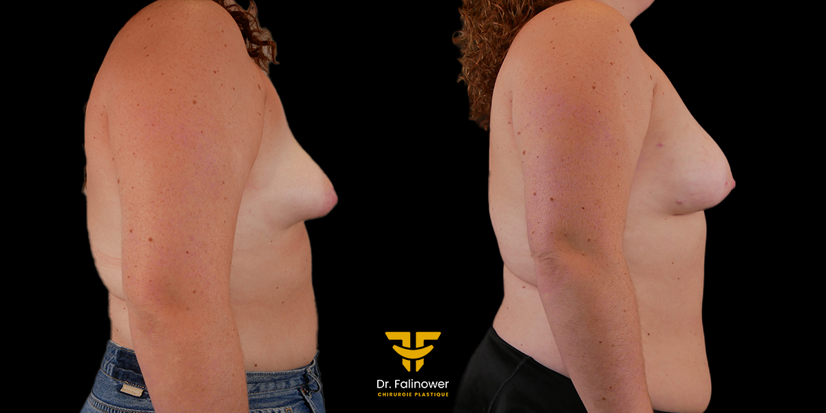 Lipofilling mammaire patient 1