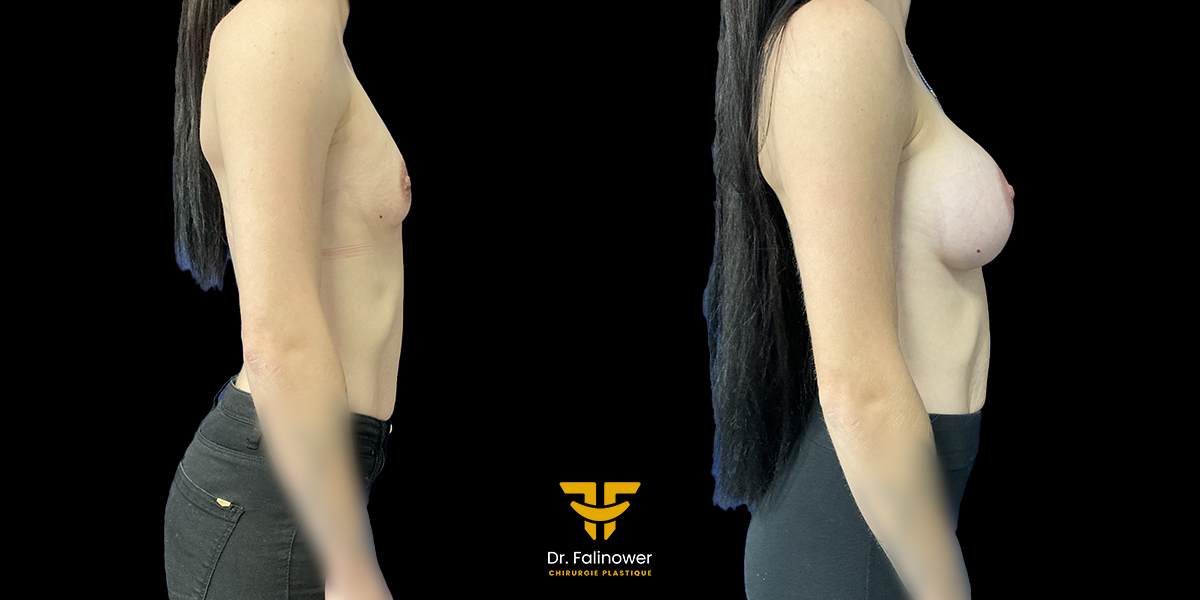 Augmentation mammaire par prothèses patient 6