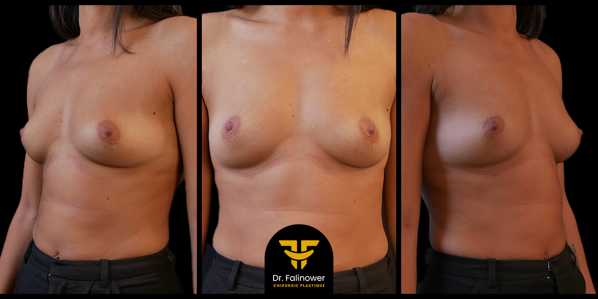 Photos Avant/Après Augmentation mammaire par prothèses patient 8