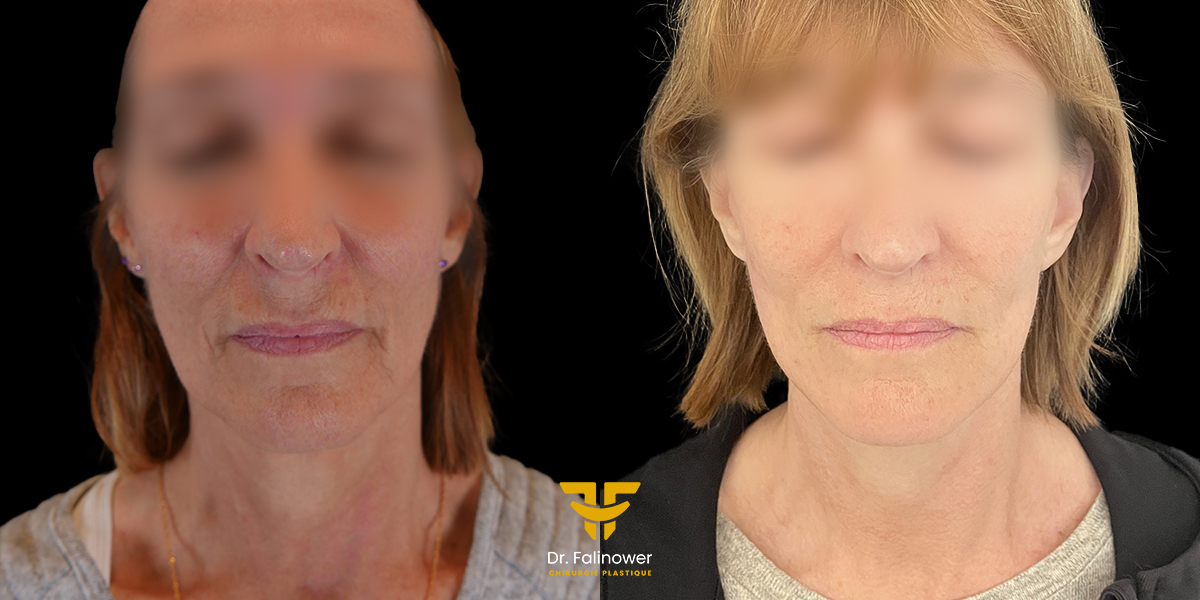 Lifting cervico-facial à Montpellier