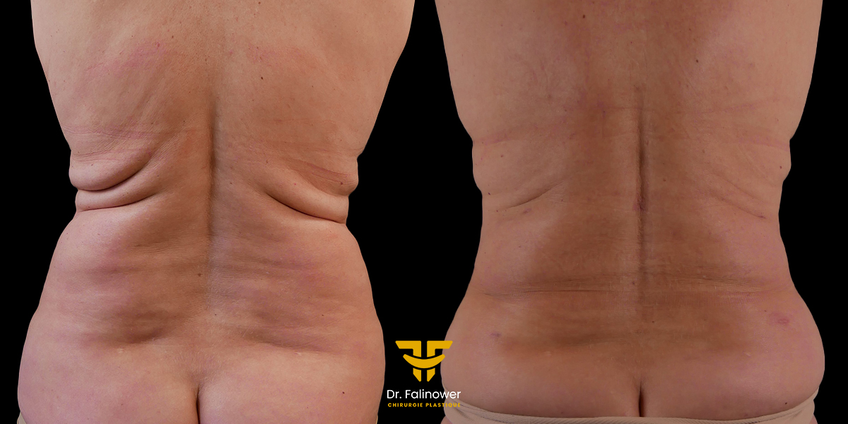 Lipoaspiration et bodityte à Montpellier