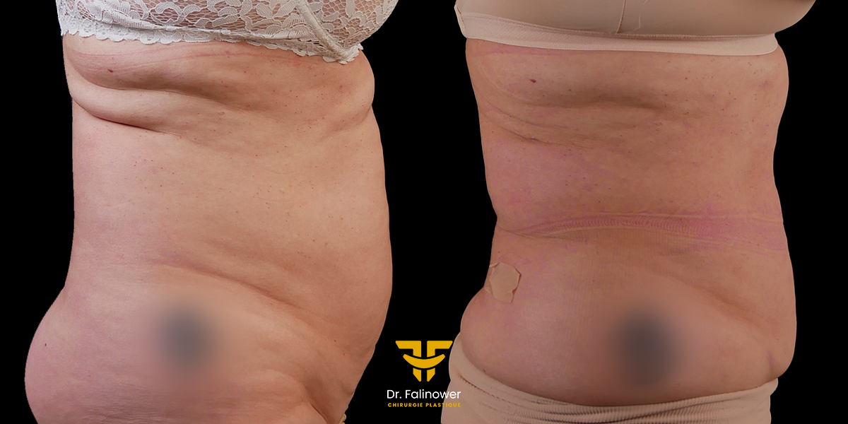 Lipoaspiration et bodityte à Montpellier