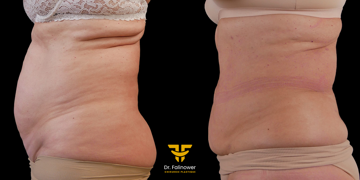 Lipoaspiration et bodityte à Montpellier