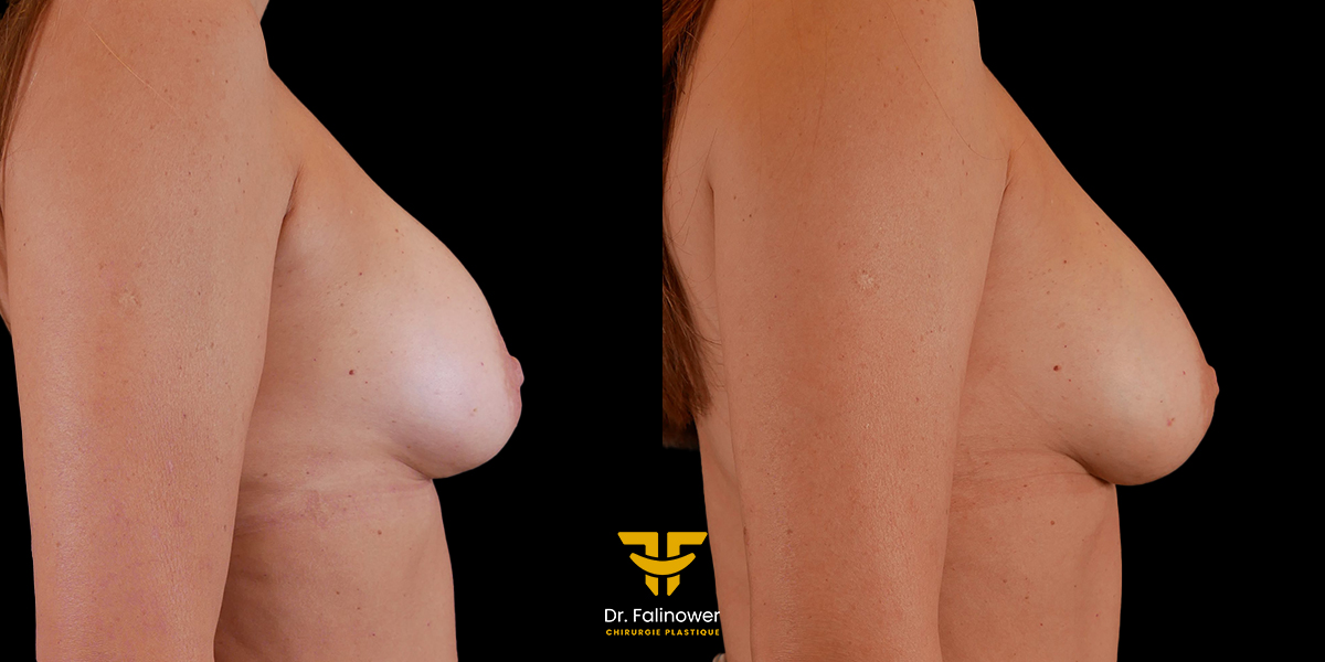 Augmentation mammaire par lipofilling à Montpellier