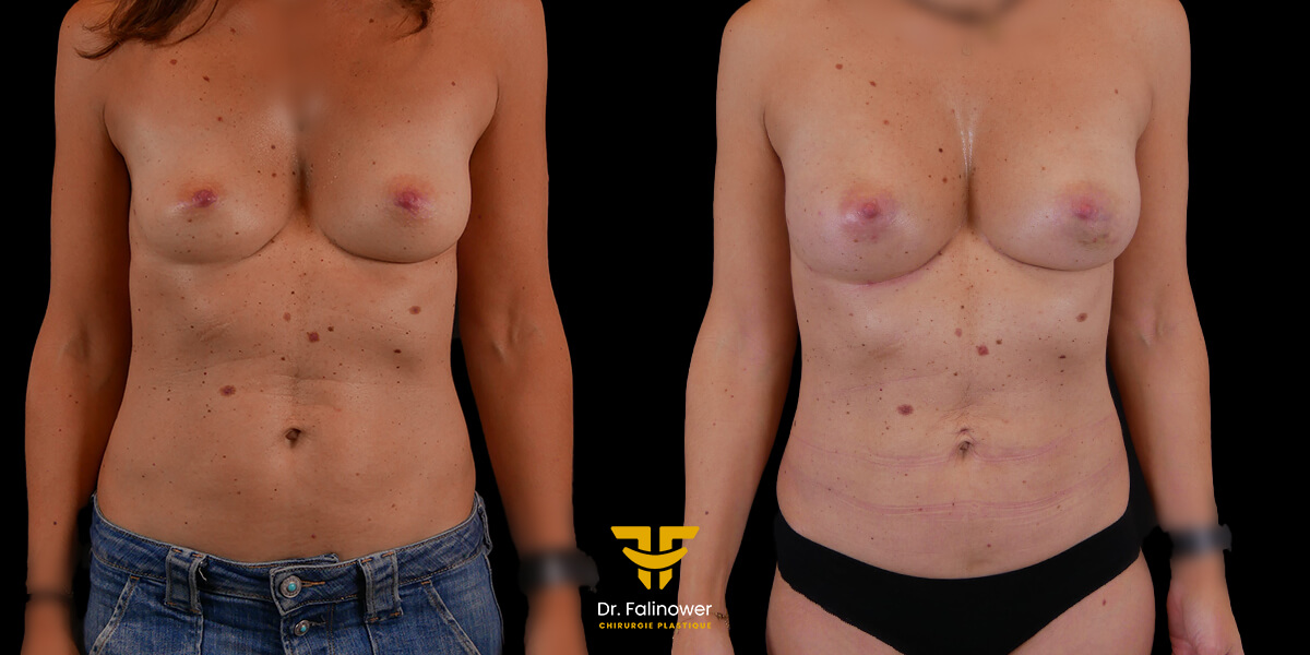 Augmentation mammaire par lipofilling à Montpellier