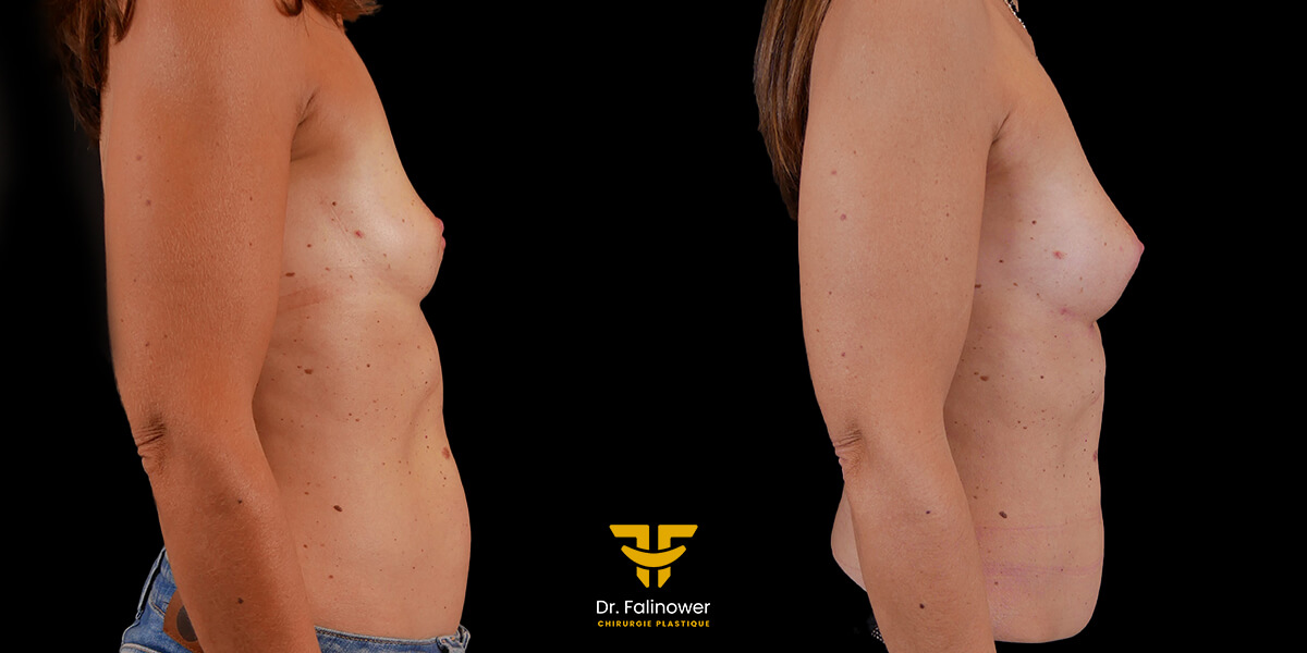 Augmentation mammaire par lipofilling à Montpellier