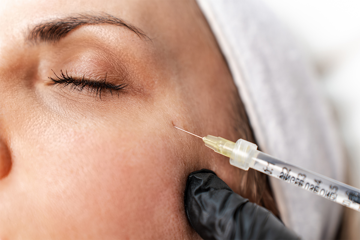 Injection d'acide hyaluronique à Montpellier
