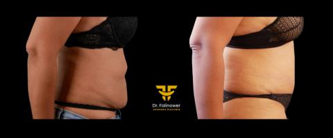 Abdominoplastie patiente 1 droit