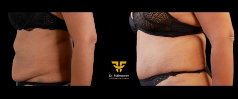 Abdominoplastie patiente 1 gauche