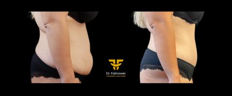 Abdominoplastie patiente 2 droit