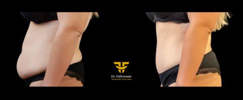 Abdominoplastie patiente 2 gauche