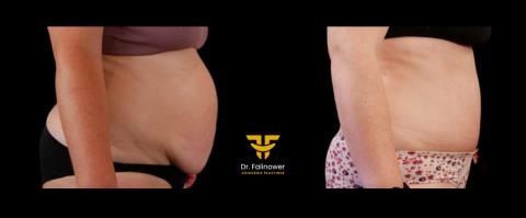 Abdominoplastie patiente 3 droit