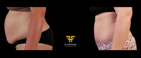 Abdominoplastie patiente 3 gauche