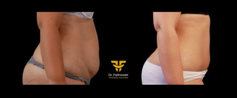 Abdominoplastie patiente 4 droit