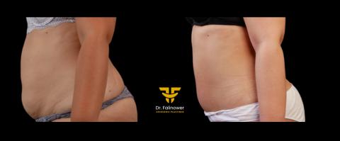 Abdominoplastie patiente 4 gauche