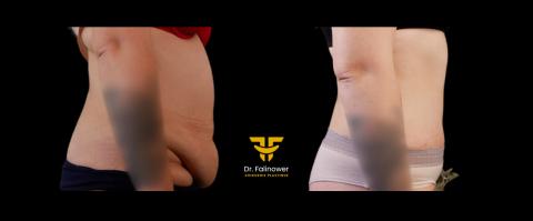 Abdominoplastie patiente 5 droit 1