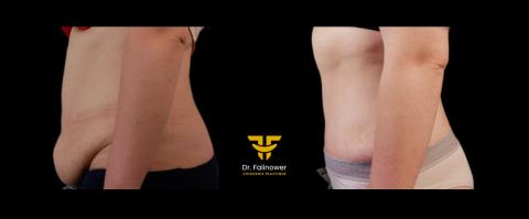 Abdominoplastie patiente 5 gauche 2