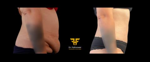 Abdominoplastie patiente 5 droit 2