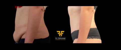 Abdominoplastie patiente 5 gauche 2