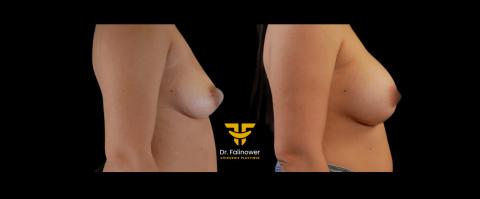 Prothèse mammaire patiente 2 droit