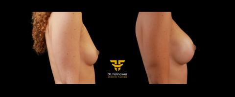 Prothèse mammaire patiente 3 droite