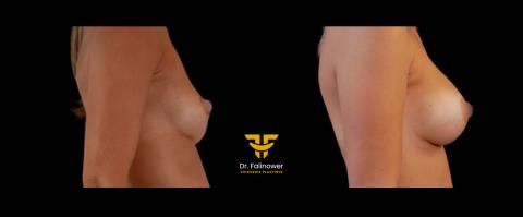 Prothèse mammaire patiente 4 droite 2