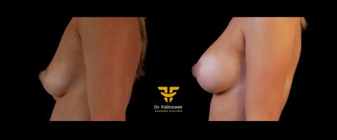 Prothèse mammaire patiente 4 gauche 2