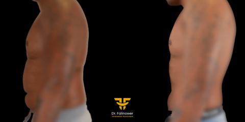 Lipoaspiration du corps patient 1 profil droit