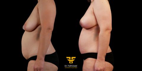 Mommy makeover patient 1 face