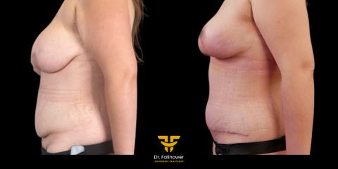 Réduction mammaire patient 2