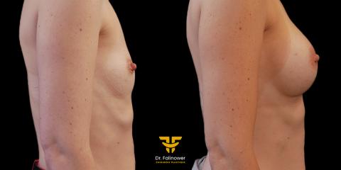 Photos Avant/Après Augmentation mammaire par prothèses patient 9