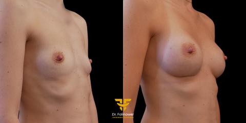 Photos Avant/Après Augmentation mammaire par prothèses patient 9