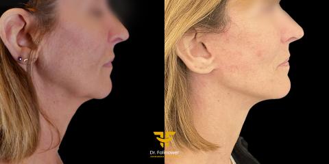 Lifting cervico-facial à Montpellier