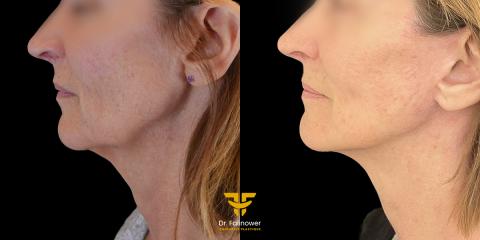 Lifting cervico-facial à Montpellier