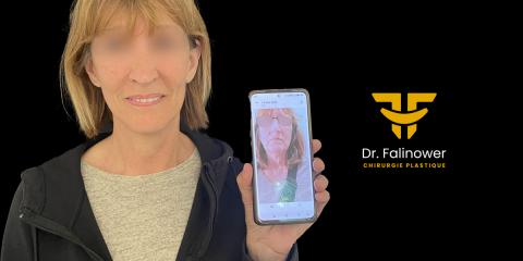 Lifting cervico-facial à Montpellier