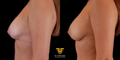 Augmentation mammaire par lipofilling à Montpellier