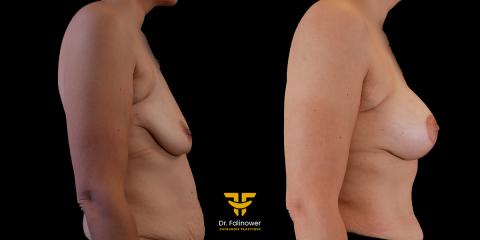 Mastopexie et prothèses mammaire à Montpellier