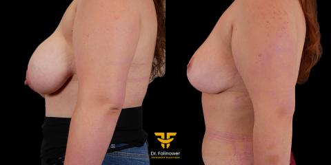 Réduction mammaire à Montpellier